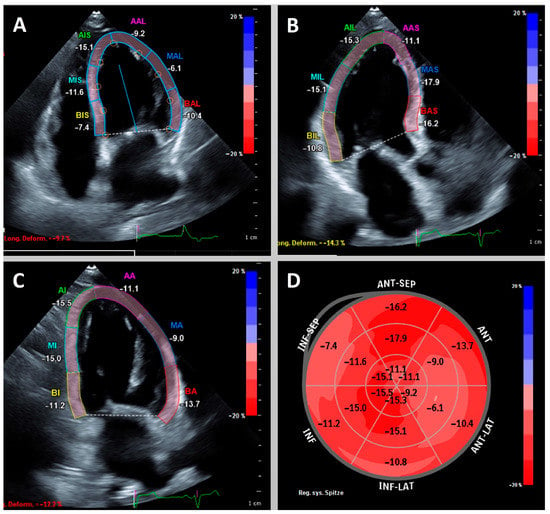 Abnormal left ventricular global longitudinal strain by speckle tracking  echocardiography in COVID-19 patients
