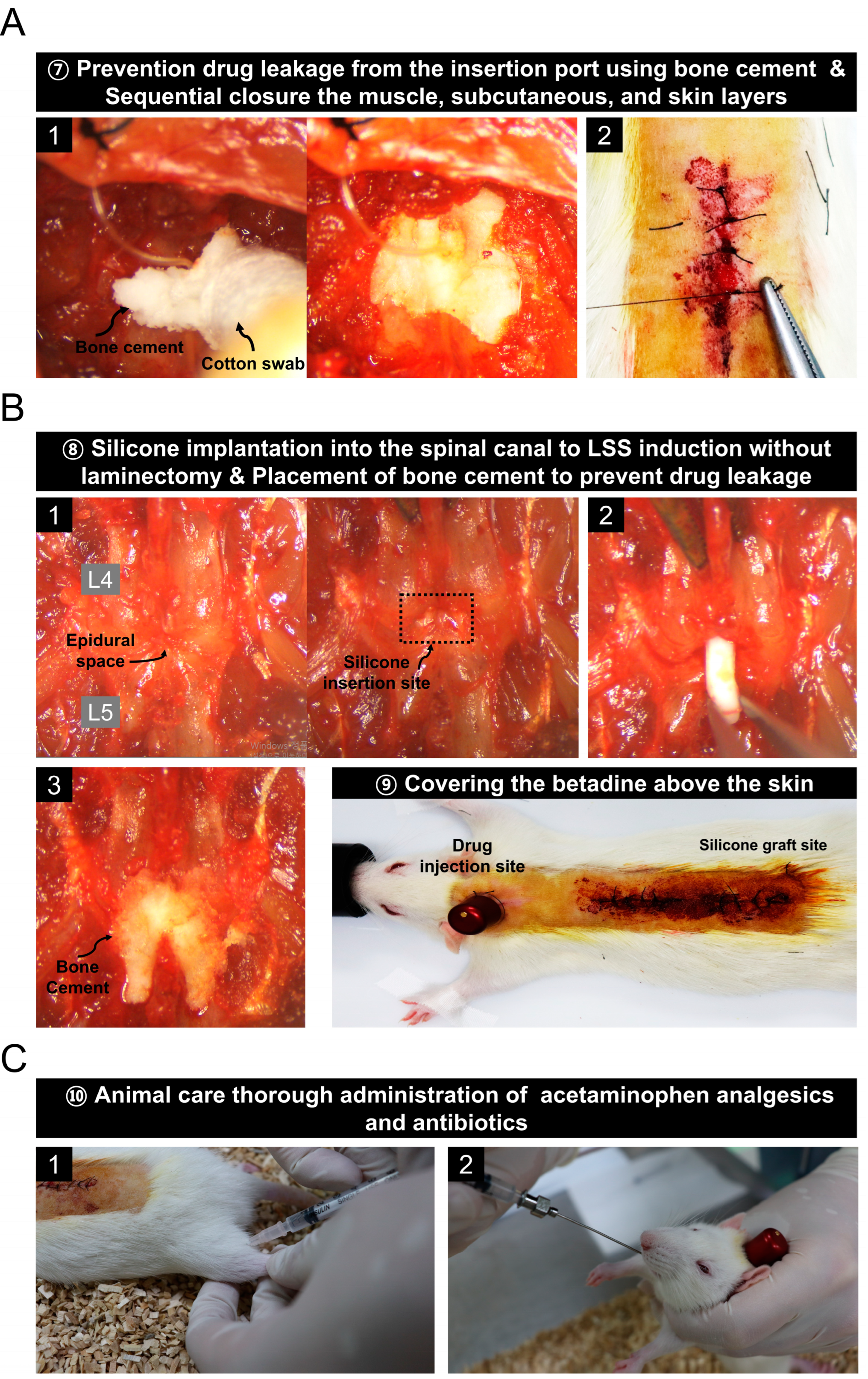 Intracorporeal End-to-Side Esophagojejunostomy using Lap-Jack : A New Type  of Laparoscopic Purse-string Suture Instrument - SAGES Abstract Archives