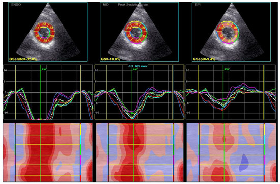 Erratum 'Prognostic implication of relative regional strain ratio in  cardiac amyloidosis