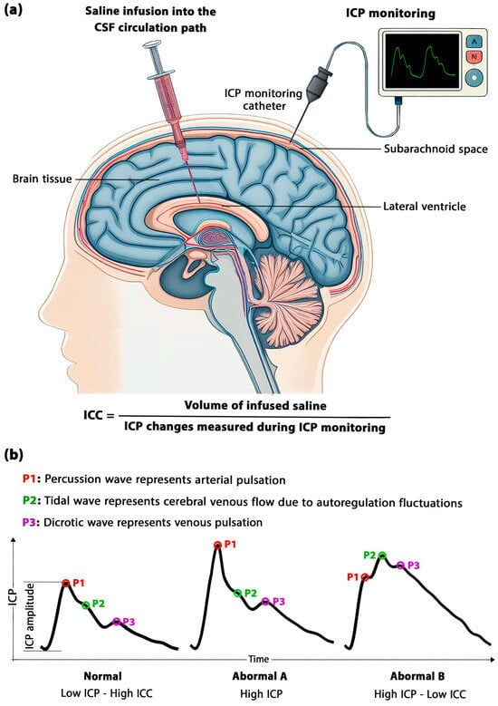 Long-term recovery behavior of brain tissue in hydrocephalus patients after  shunting