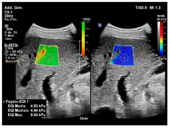 Quantitative ultrasound imaging of soft biological tissues: a