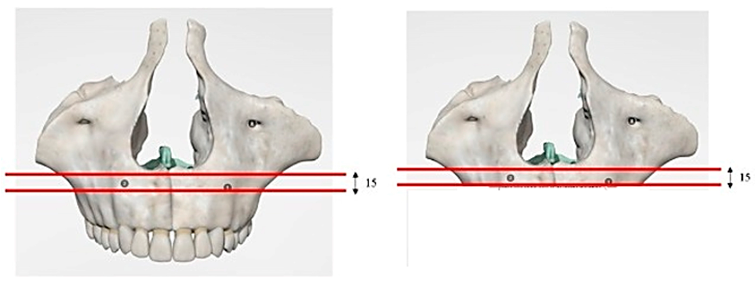 Medical Science Monitor  Biomechanical Behavior of All-on-4 and M-4  Configurations in an Atrophic Maxilla: A 3D Finite Element Method - Article  abstract #929908