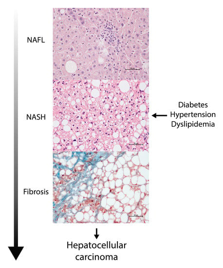 Biomolecules Free Full Text Coupling Machine Learning And Lipidomics As A Tool To Investigate Metabolic Dysfunction Associated Fatty Liver Disease A General Overview Html