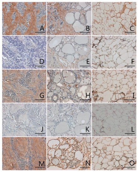 Biomolecules Free Full Text Contribution Of Glycation And Oxidative Stress To Thyroid Gland Pathology A Pilot Study Html