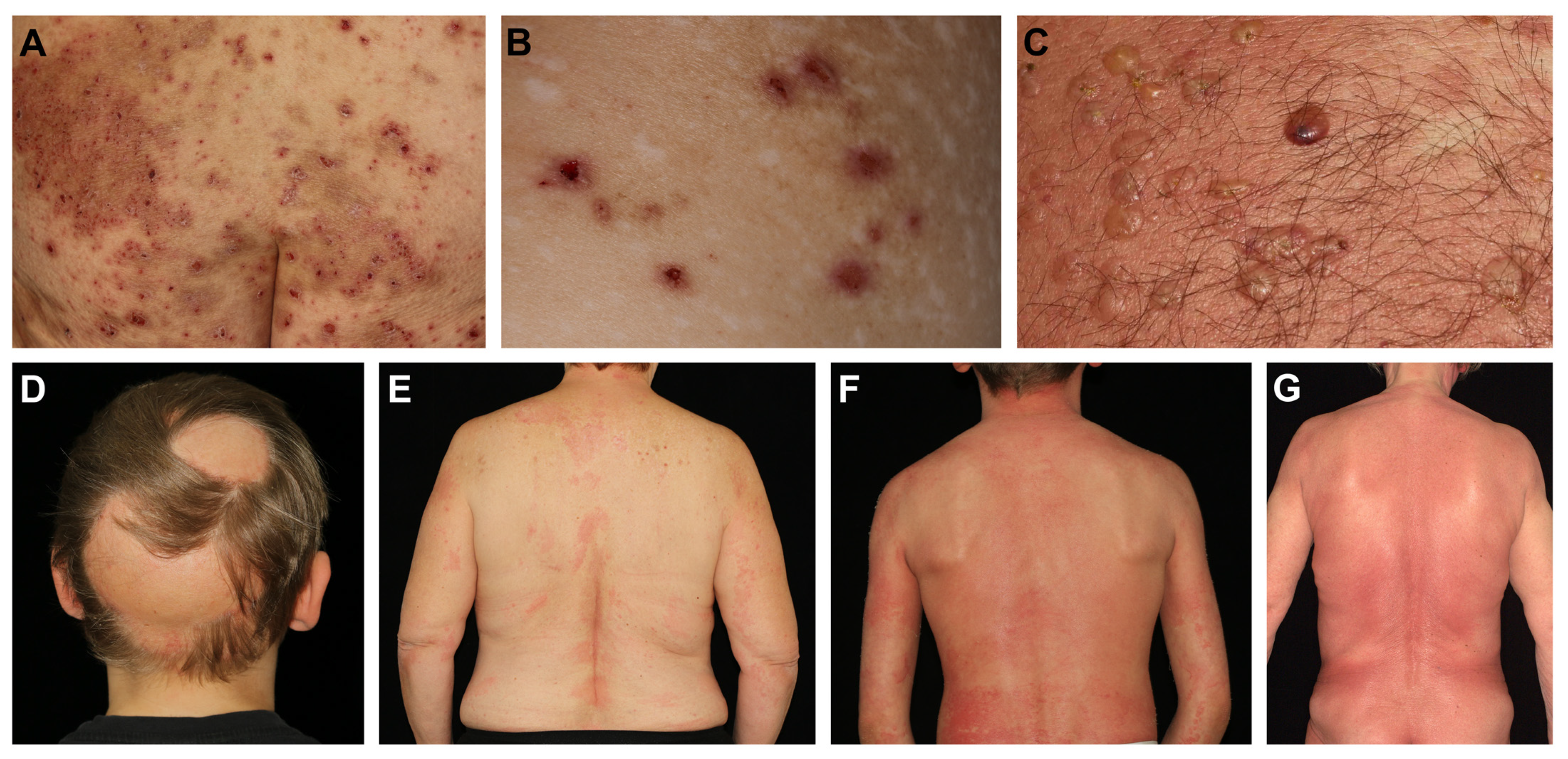 Biomolecules | Free Full-Text | Dupilumab in Inflammatory Skin Diseases: A  Systematic Review