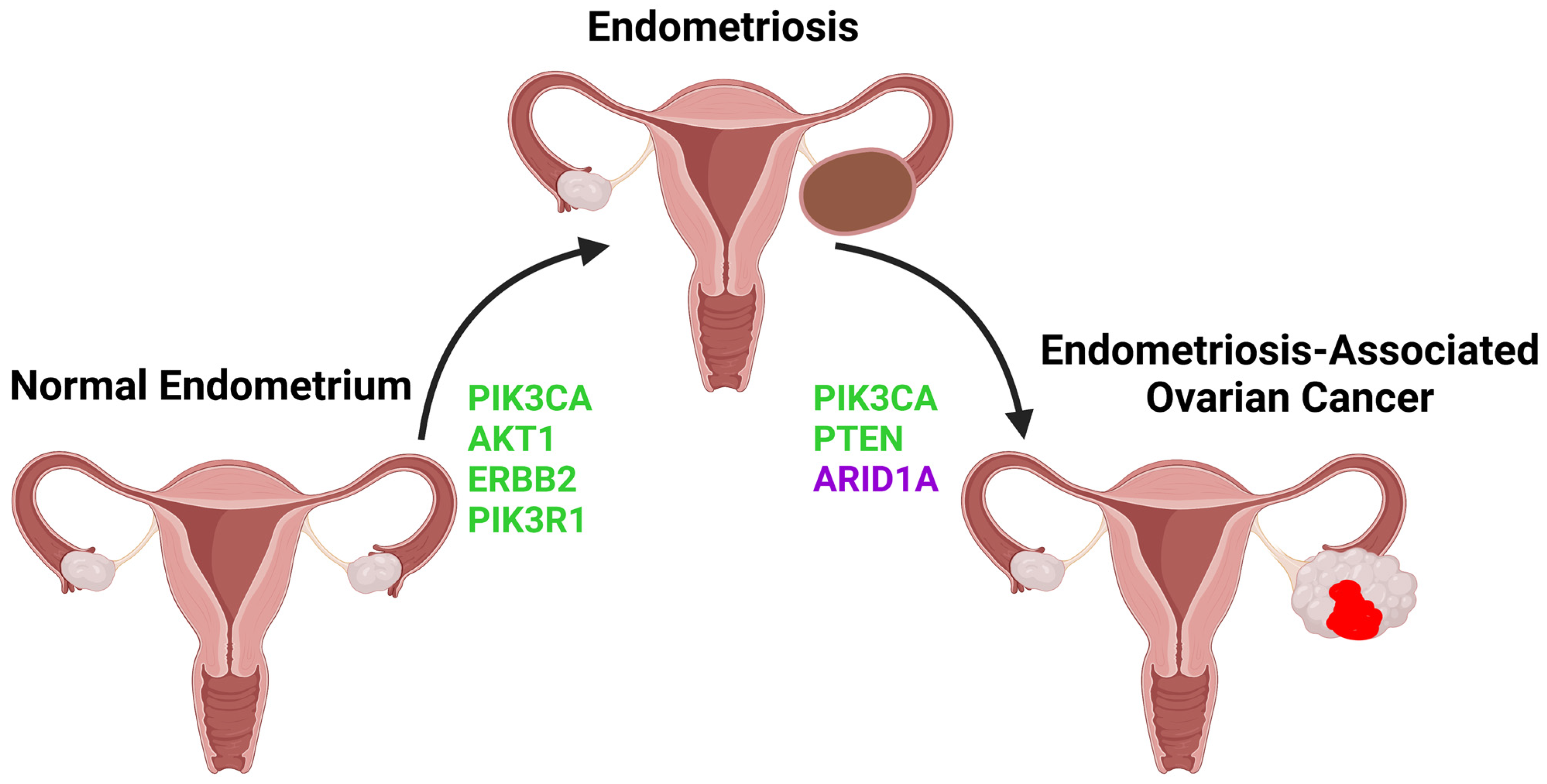 Endometriosis and ruptured cysts: What to know