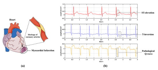 Rapid ID - EKG & Myocardial Infarction