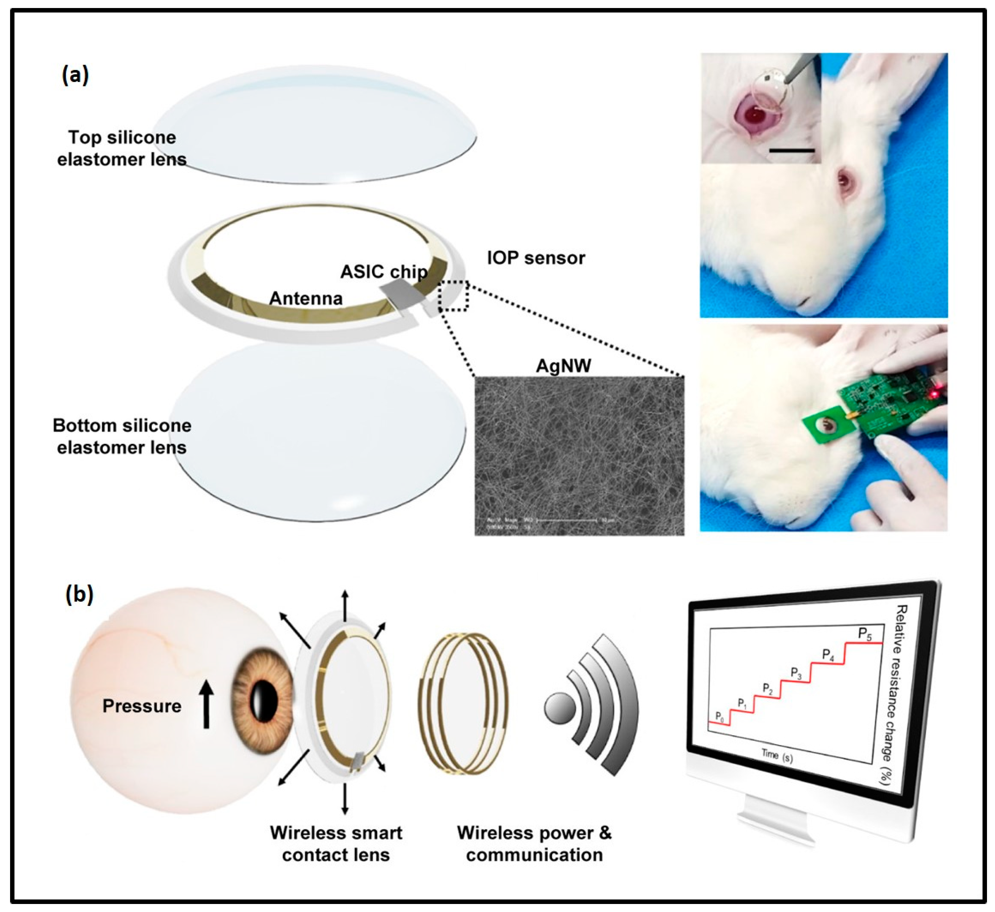 Eye-pressure-sensing contact lens both monitors and manages glaucoma