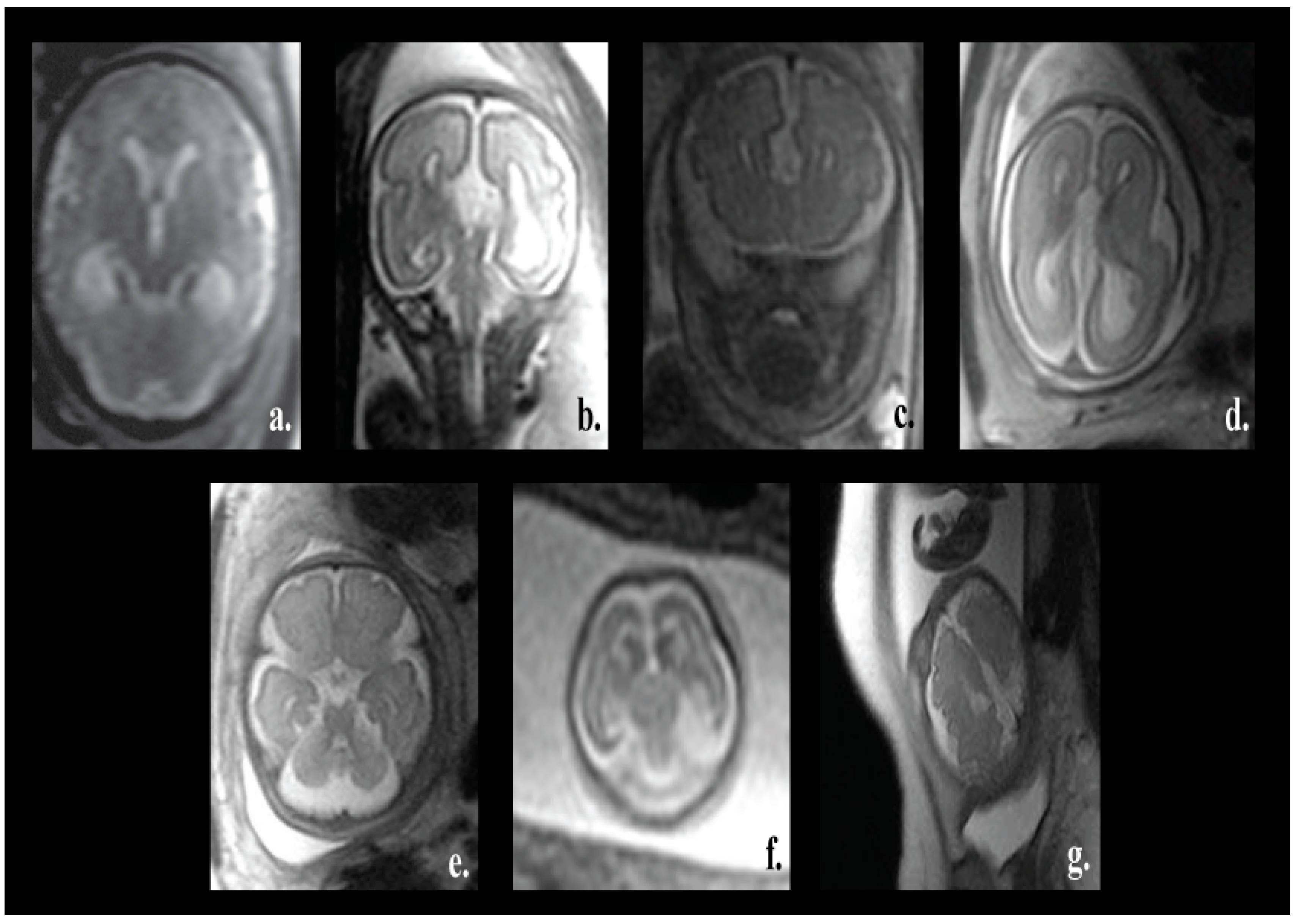 Brain Sciences Free Full Text Fetal Brain Abnormality Classification From Mri Images Of Different Gestational Age Html