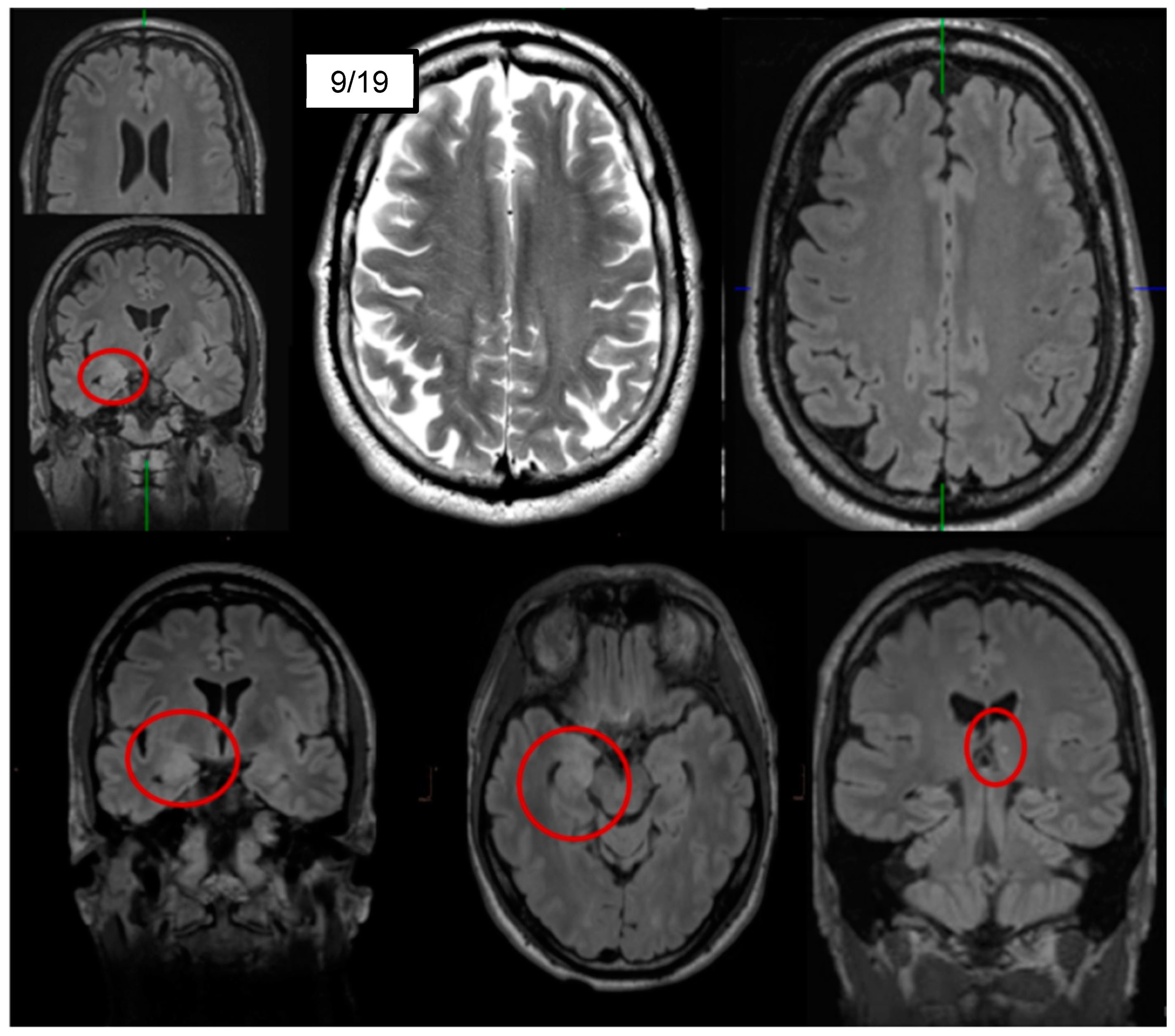 Brain Sciences | Free Full-Text | Psychiatric Manifestation of Anti-LGI1  Encephalitis