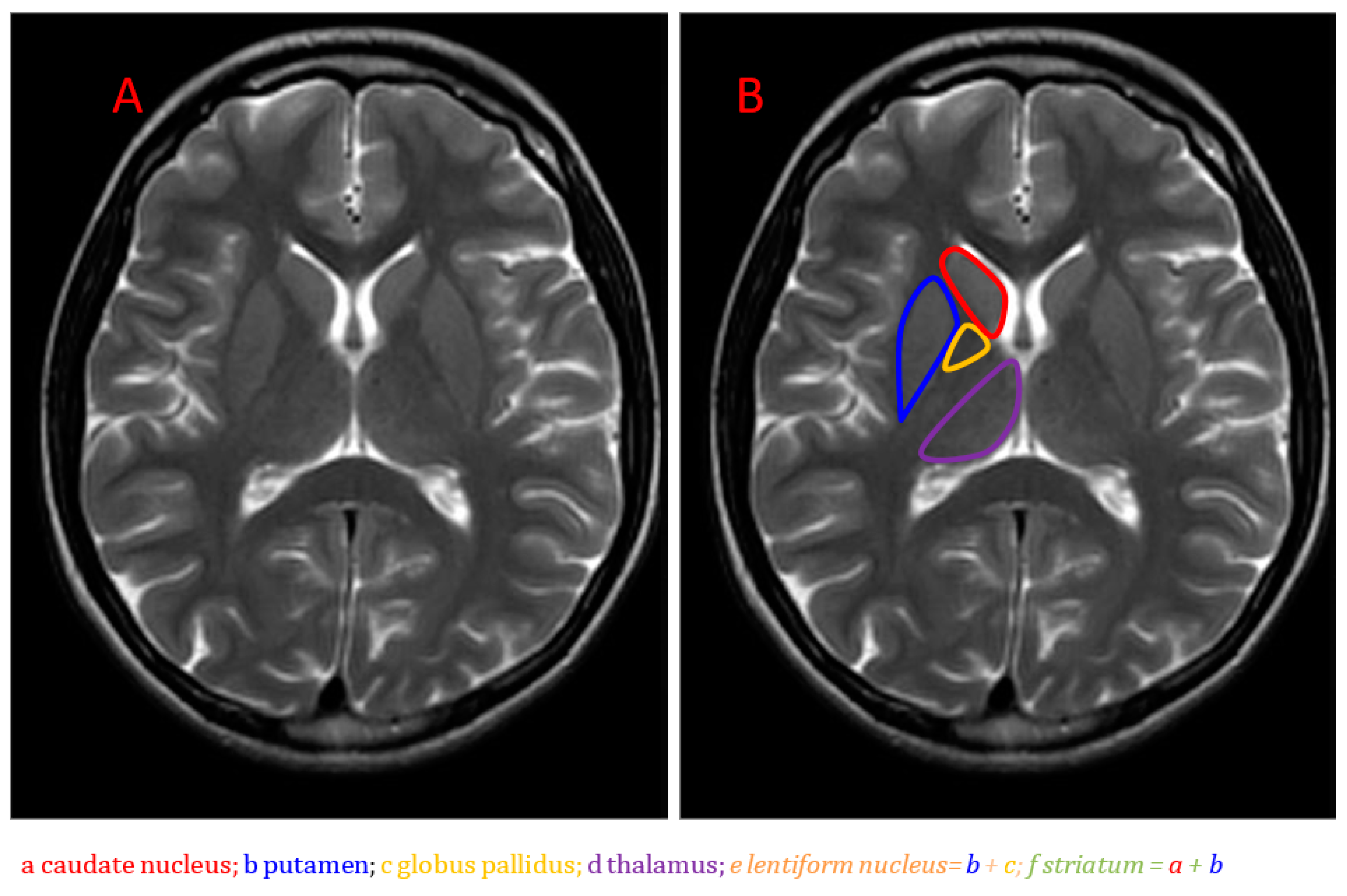 Stoop jury meditation Brain Sciences | Free Full-Text | Neuroimaging of Basal Ganglia in  Neurometabolic Diseases in Children