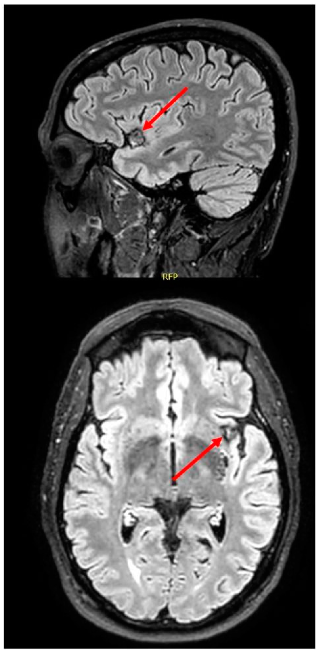 Just thinking about doing a math problem causes some people's posterior  insula—the part of the brain that reacts when you're physically…