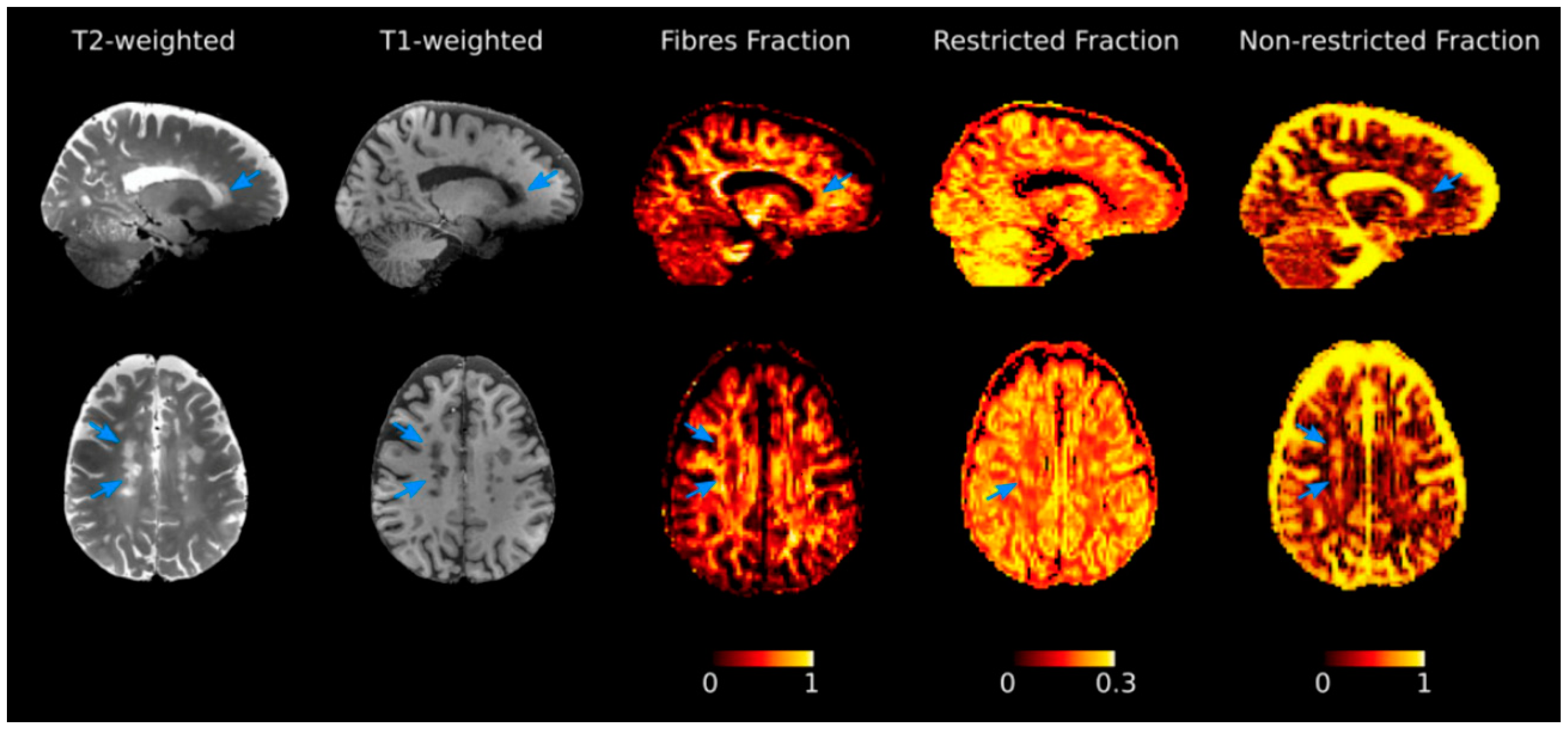 Brain Sciences | Free Full-Text | Neuroimaging Correlates of Cognitive  Dysfunction in Adults with Multiple Sclerosis | HTML