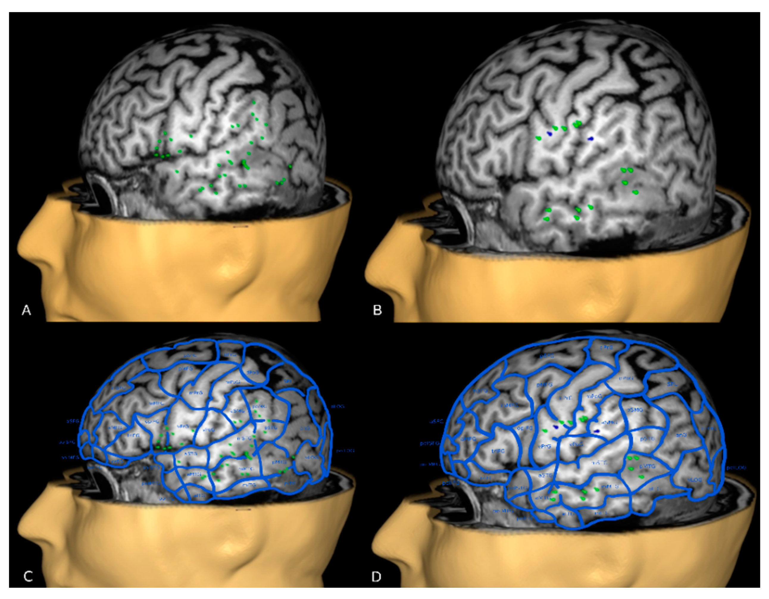 brain mapping procedure