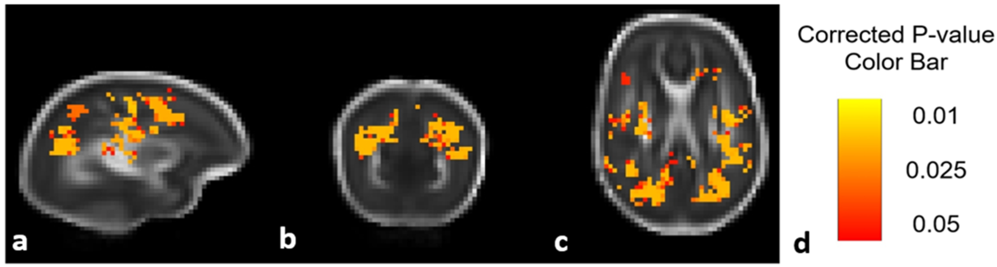 Brain Sciences Free Full Text Diffusion Tensor Imaging Changes Do Not Affect Long Term Neurodevelopment Following Early Erythropoietin Among Extremely Preterm Infants In The Preterm Erythropoietin Neuroprotection Trial Html