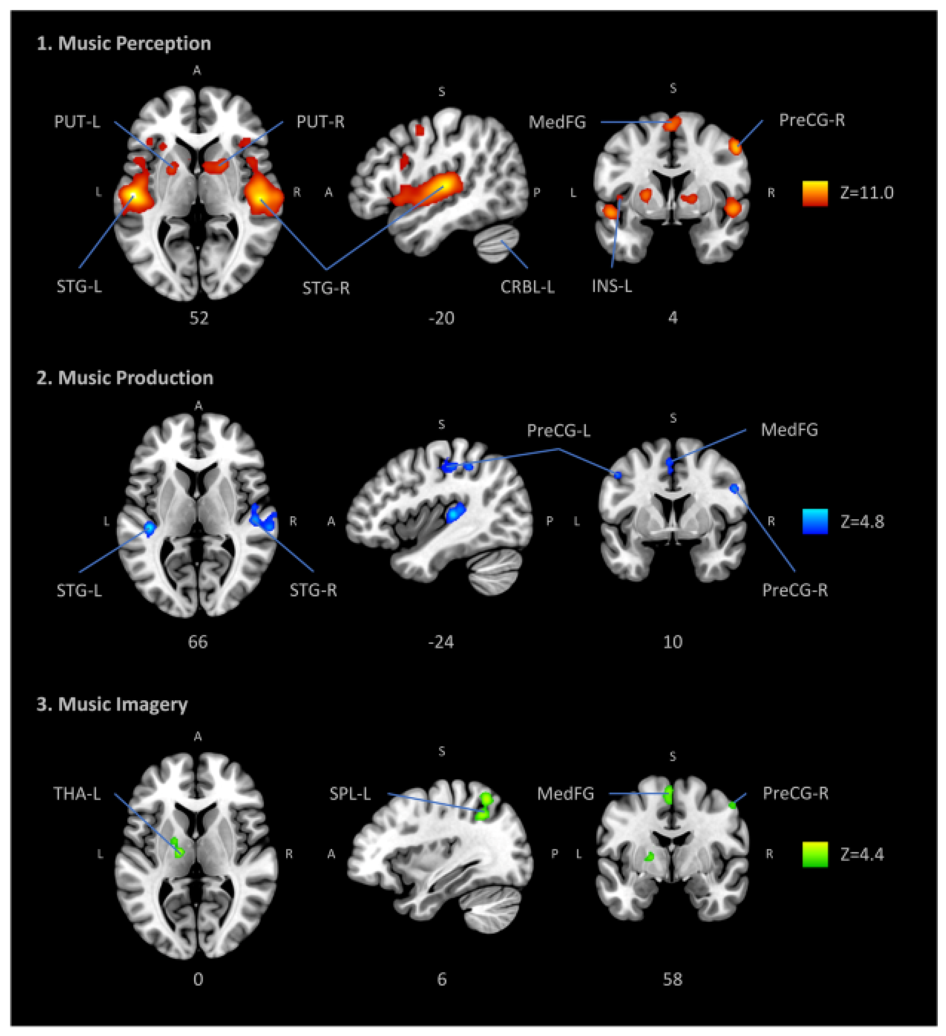 Brain Sciences | Free Full-Text | Neural Correlates of Music Listening:  Does the Music Matter? | HTML