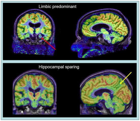 Brain Sciences | Free Full-Text | Imaging Clinical Subtypes and Associated  Brain Networks in Alzheimer&rsquo;s Disease