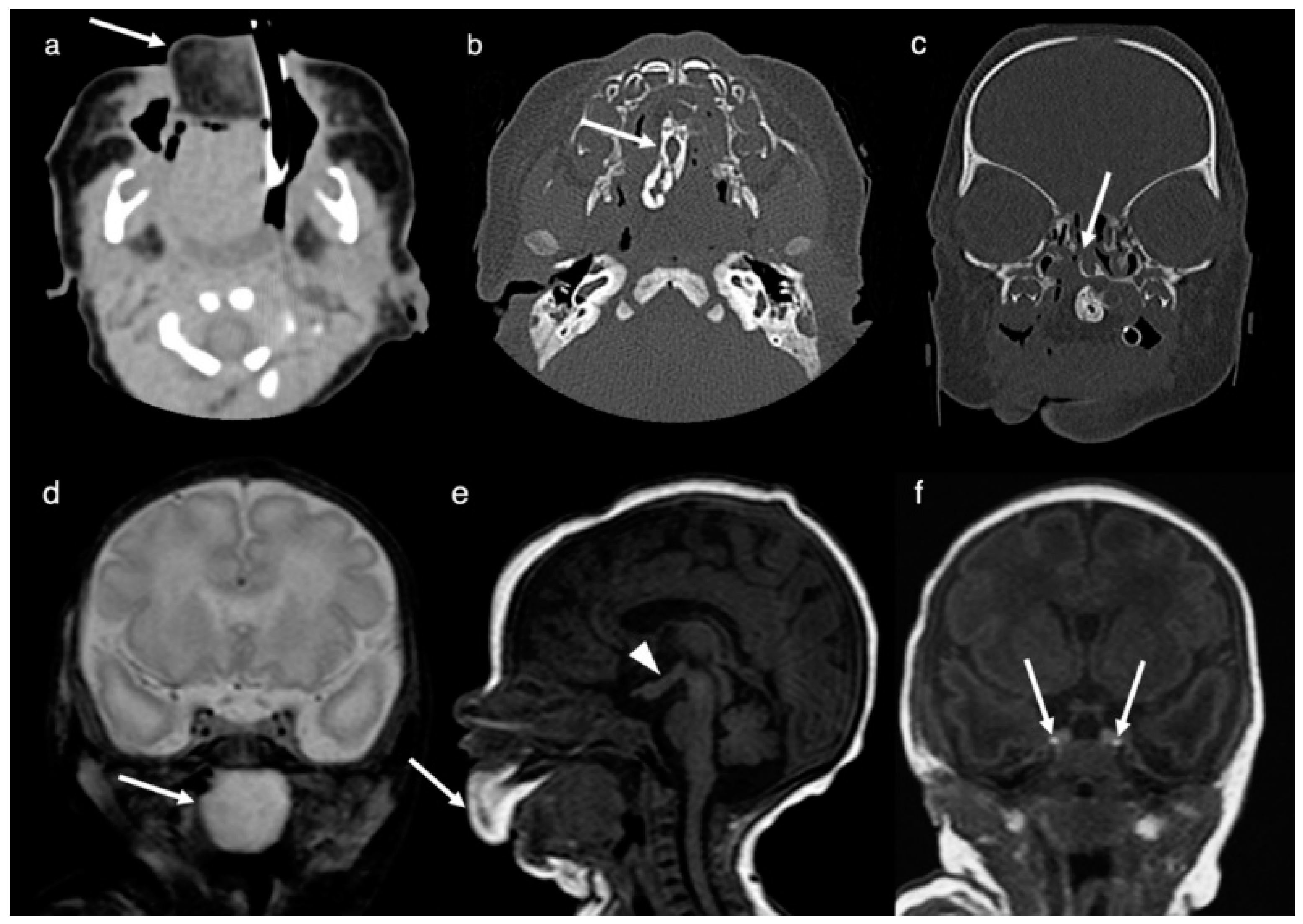 Brain Sciences | Free Full-Text | Duplication of the Pituitary Gland: CT,  MRI and DTI Findings and Updated Review of the Literature