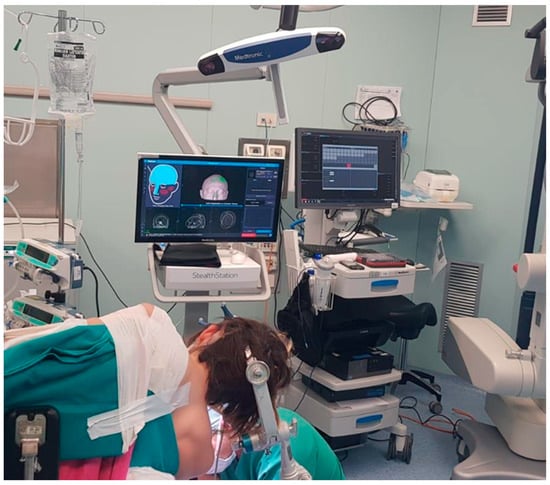 Tailored Approach and Multimodal Intraoperative Neuromonitoring in ...