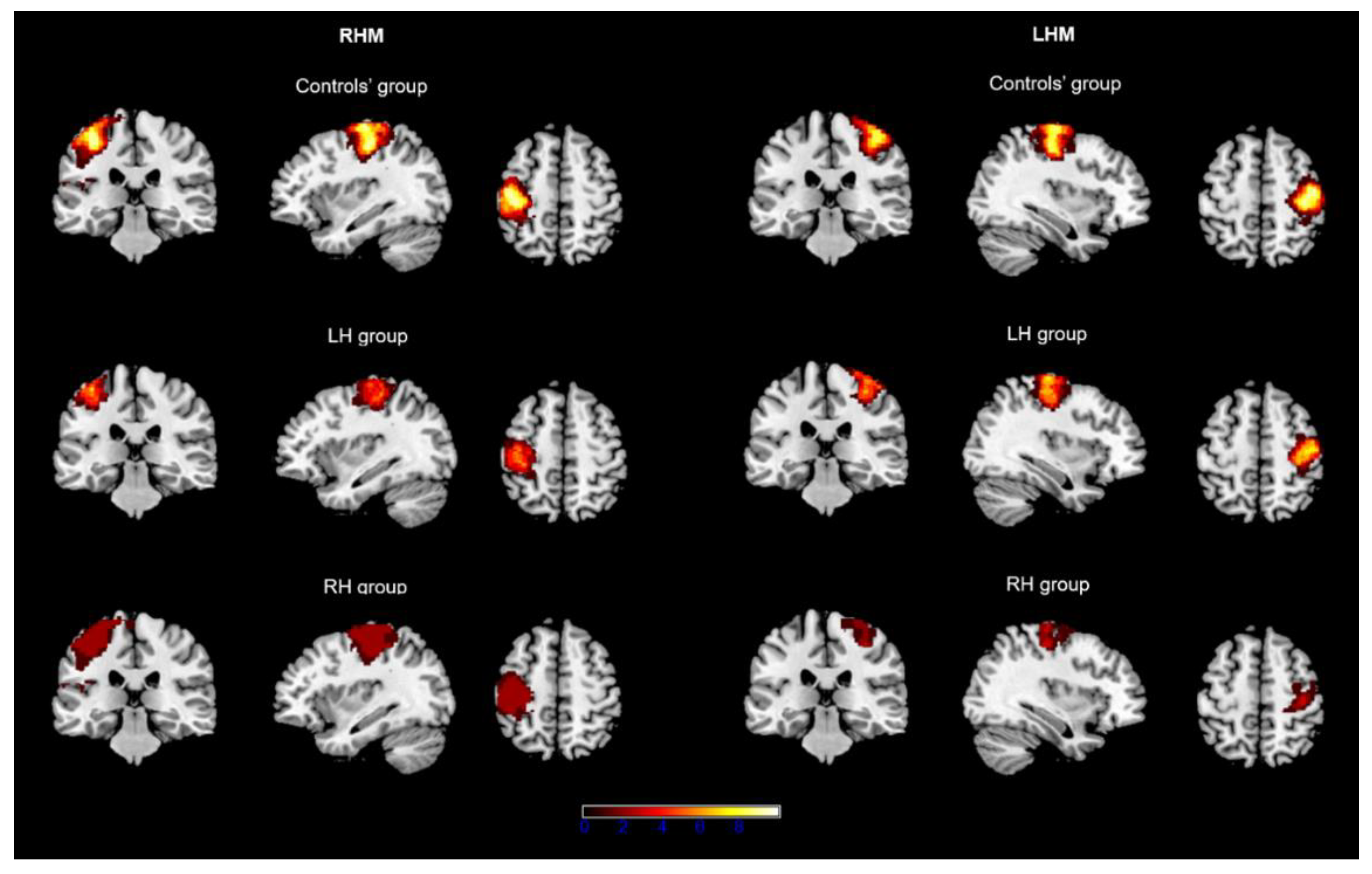 Brain Sciences | Free Full-Text | Hemispheric Asymmetry of the Hand Motor  Representations in Patients with Highly Malignant Brain Tumors:  Implications for Surgery and Clinical Practice