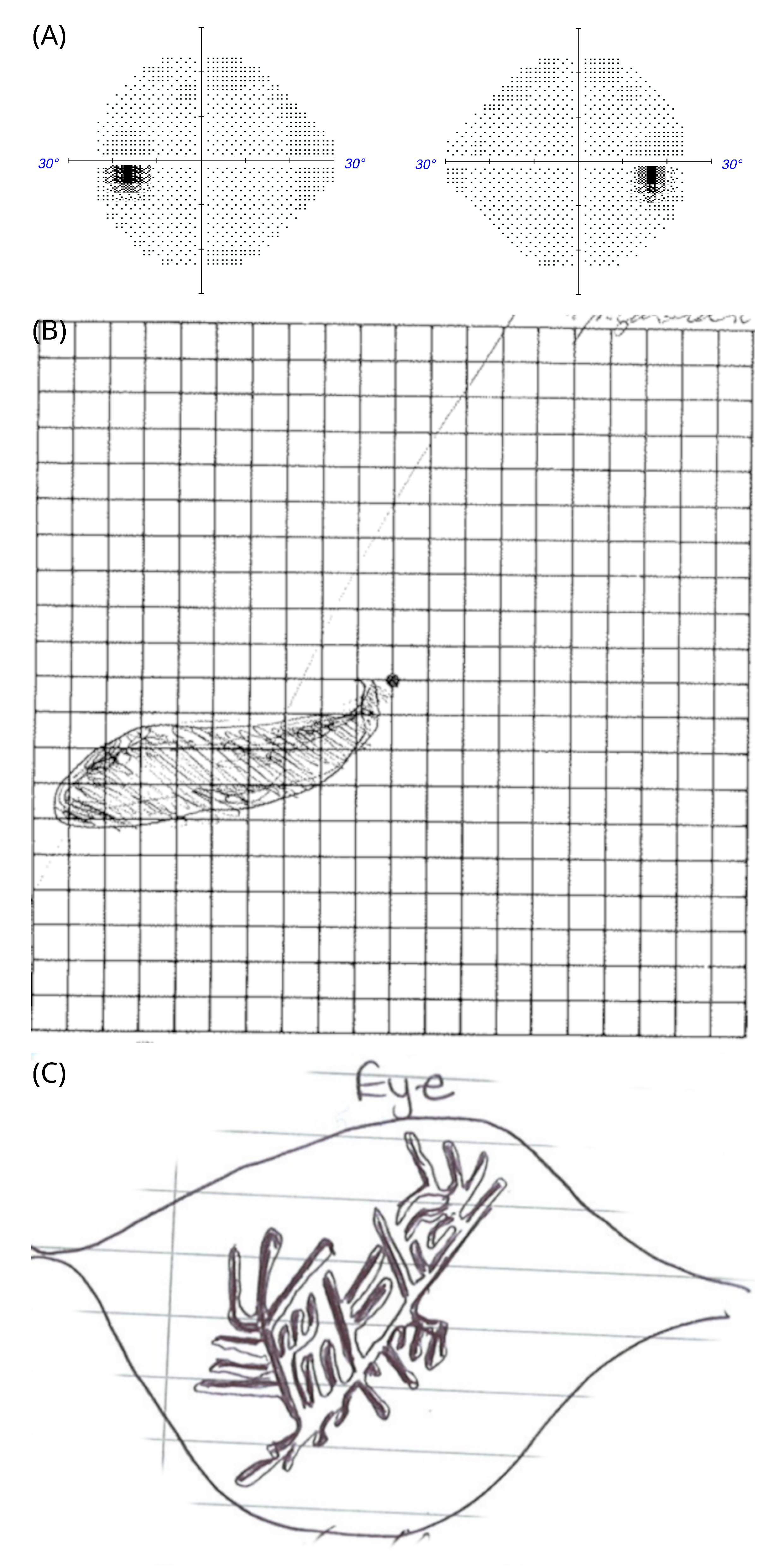 Amsler Grid Test- Retina Ophthalmology Gettysburg PA - Greater