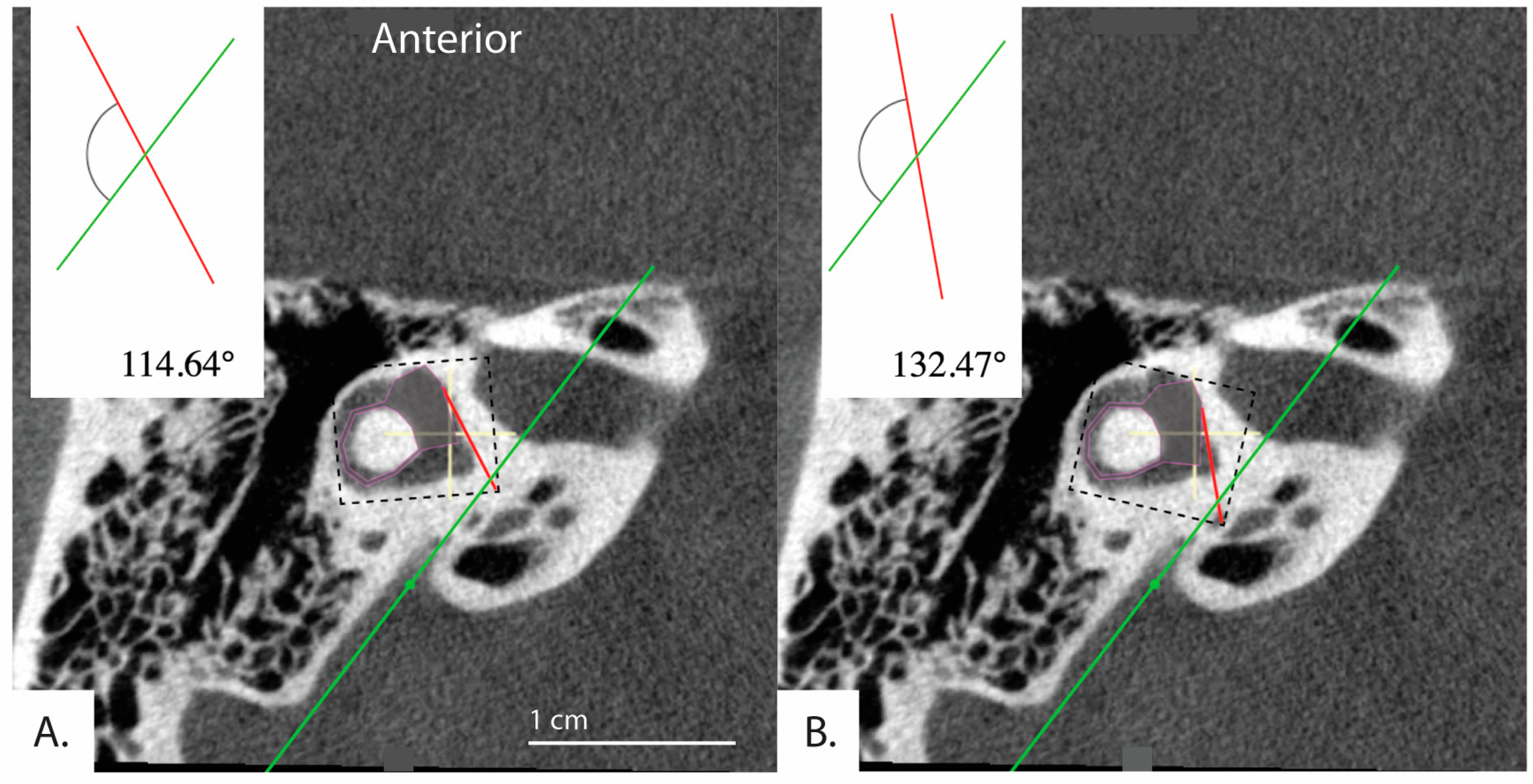 vestibular aqueduct