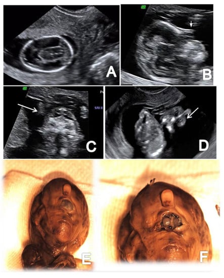 abnormal ultrasound 11 weeks