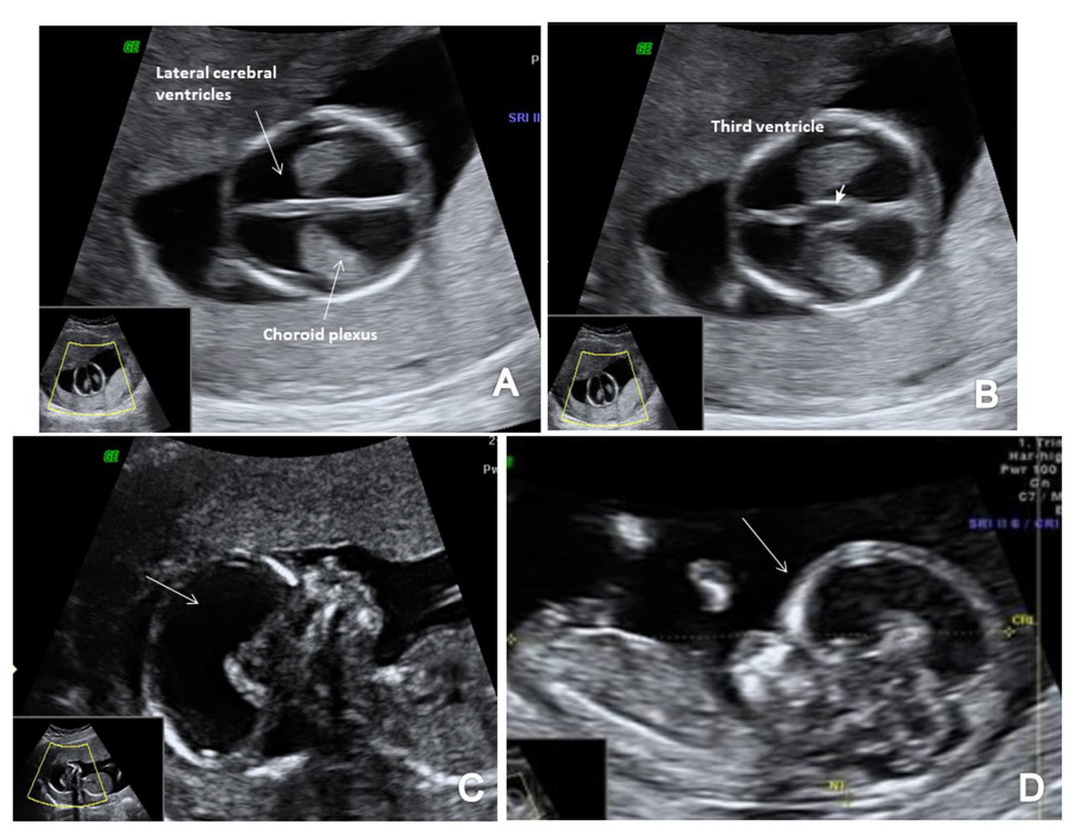 abnormal ultrasound 11 weeks