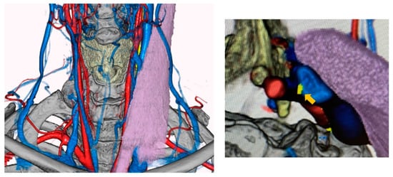 Learnings from 30 years of reported efficacy and safety of vagus