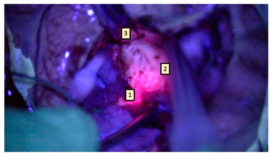 Technical Pearls to Effectively Use 5-ALA in Fluorescence-Guided Tumor  Resection—5 Lessons from the Operating Room