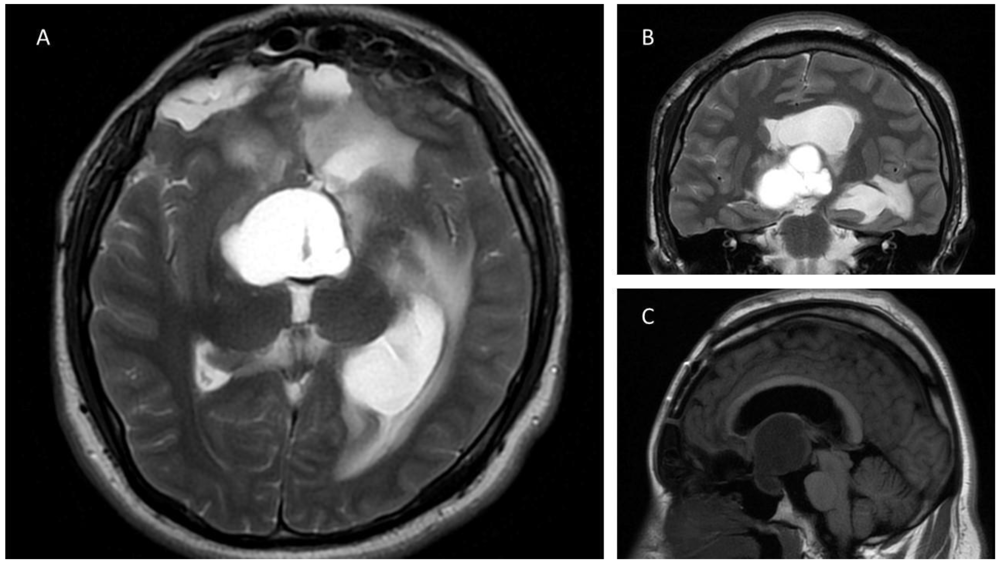 Brain Sciences Free Full Text Endoscopic Endonasal Approach In Craniopharyngiomas 