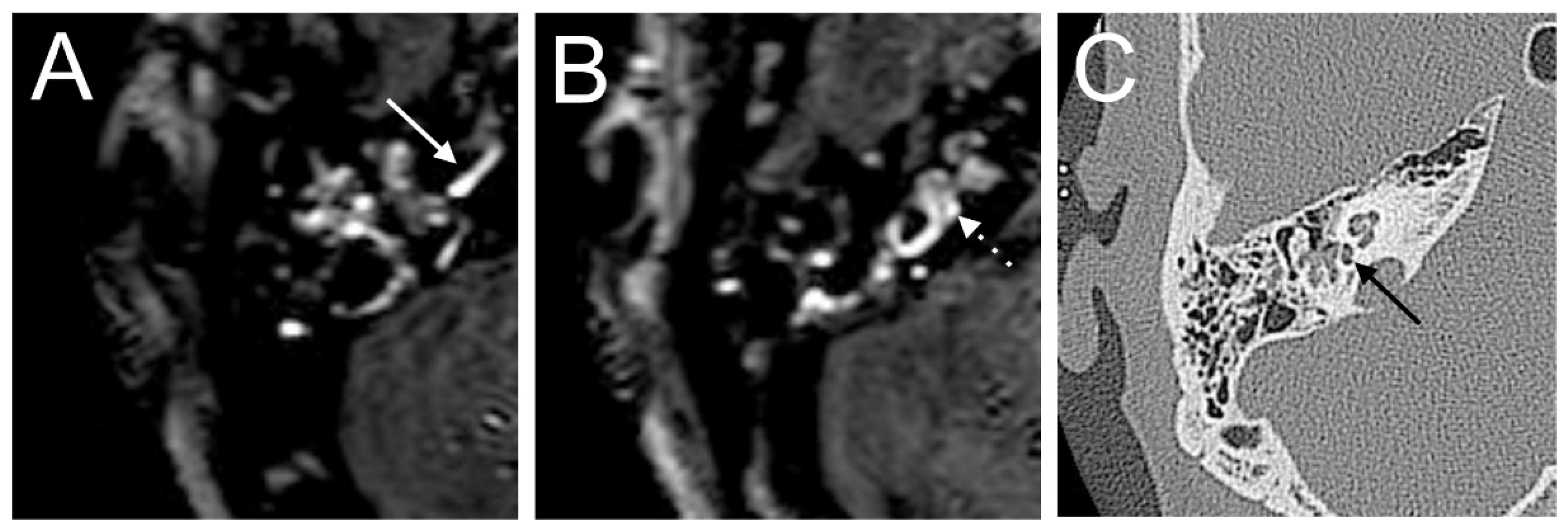 Brain Sciences | Free Full-Text | MRI-Based Inner Ear Assessment and ...