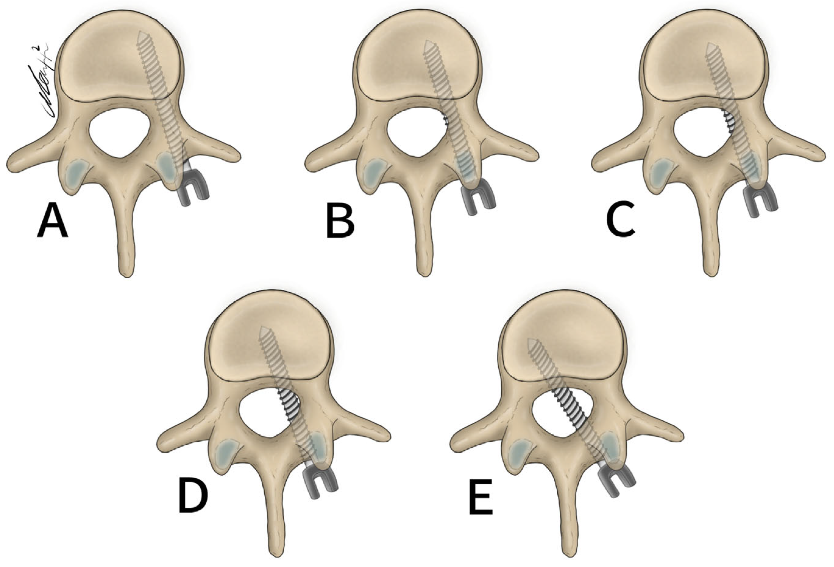 Brain Sciences Free Full Text High Accuracy Of Three Dimensional Navigated Kirschner Wire