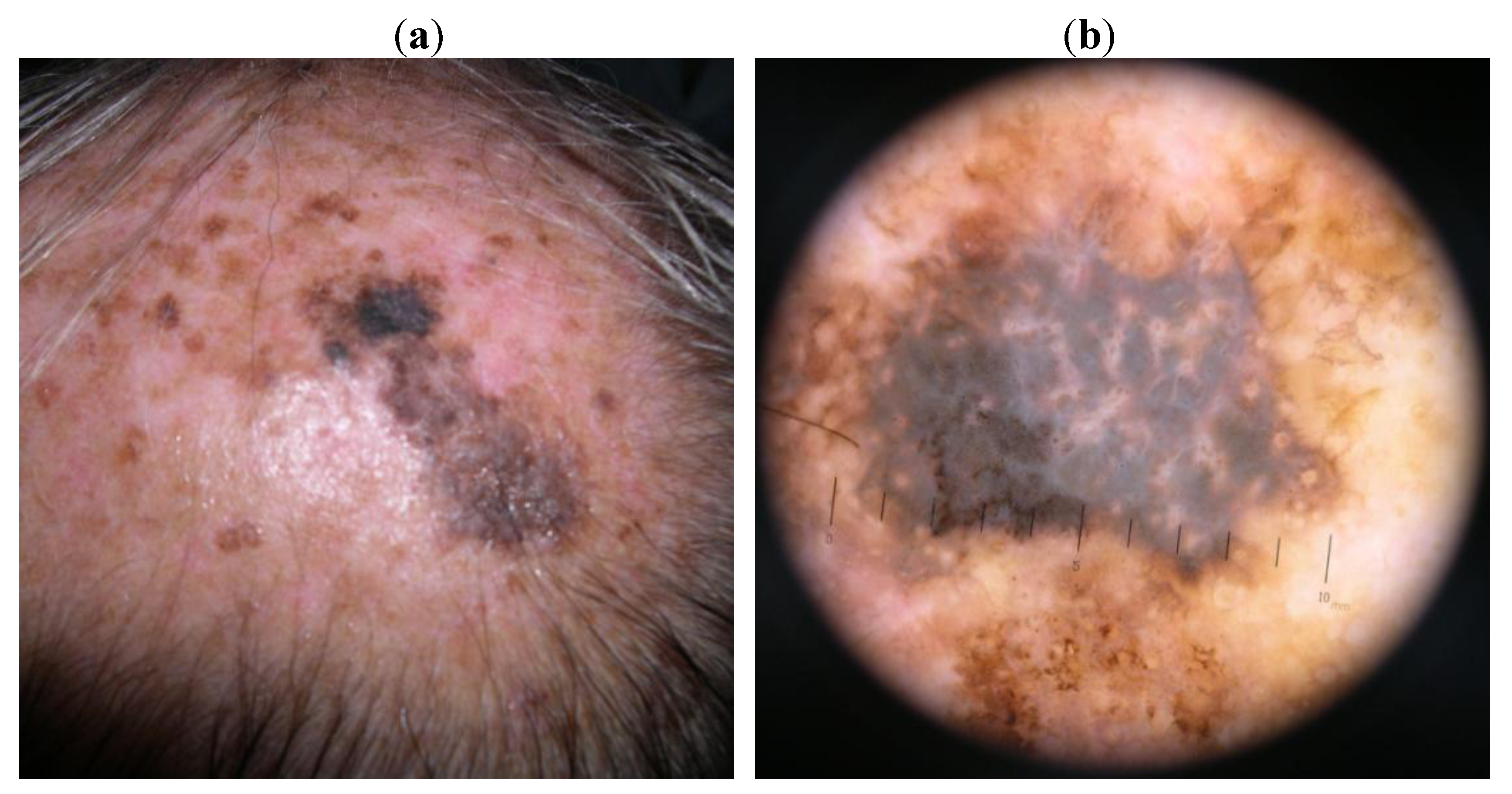 cancer-bumps-on-scalp