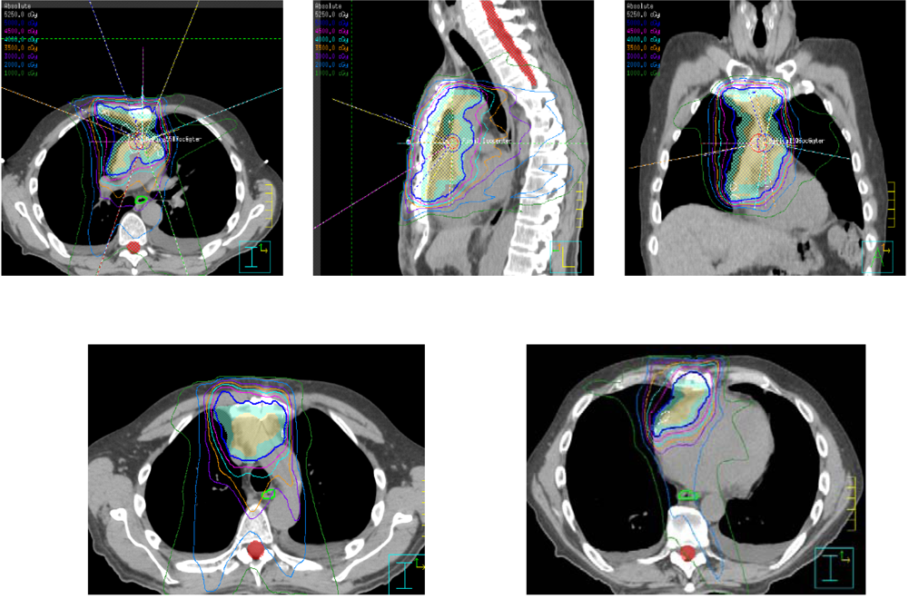 Cancers | Free Full-Text | Postoperative Radiation Therapy for Non