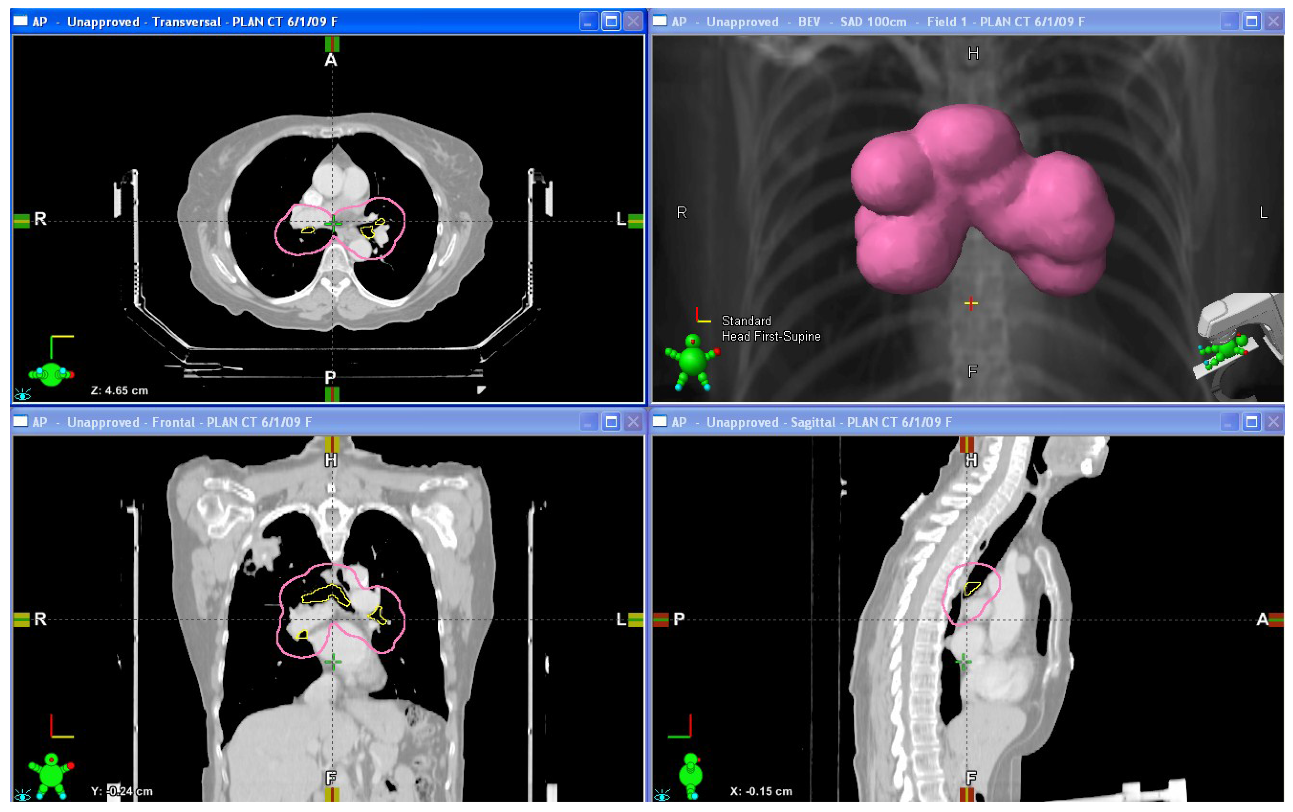 Cancers Free FullText Complications from Stereotactic