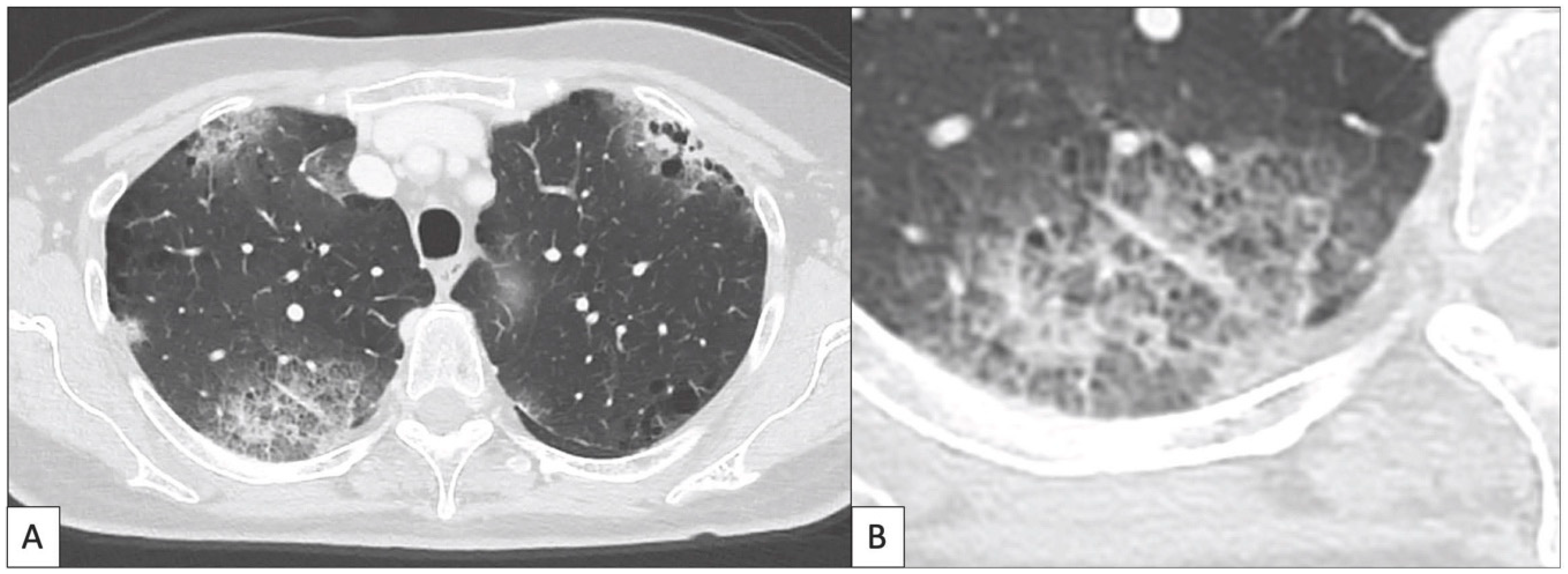 Cancers | Free Full-Text | Immunotherapy Associated Pulmonary Toxicity