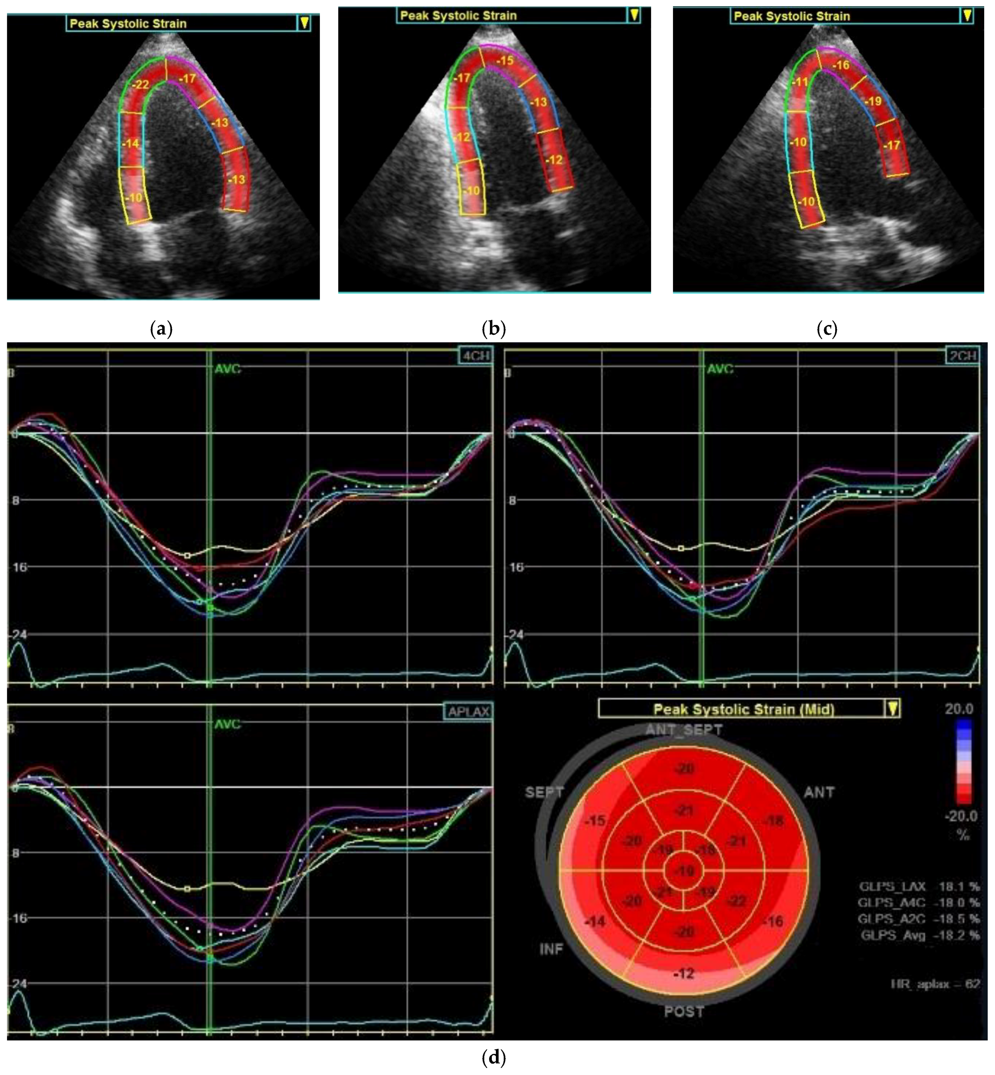 Frontiers  Echocardiographic Global Longitudinal Strain Is