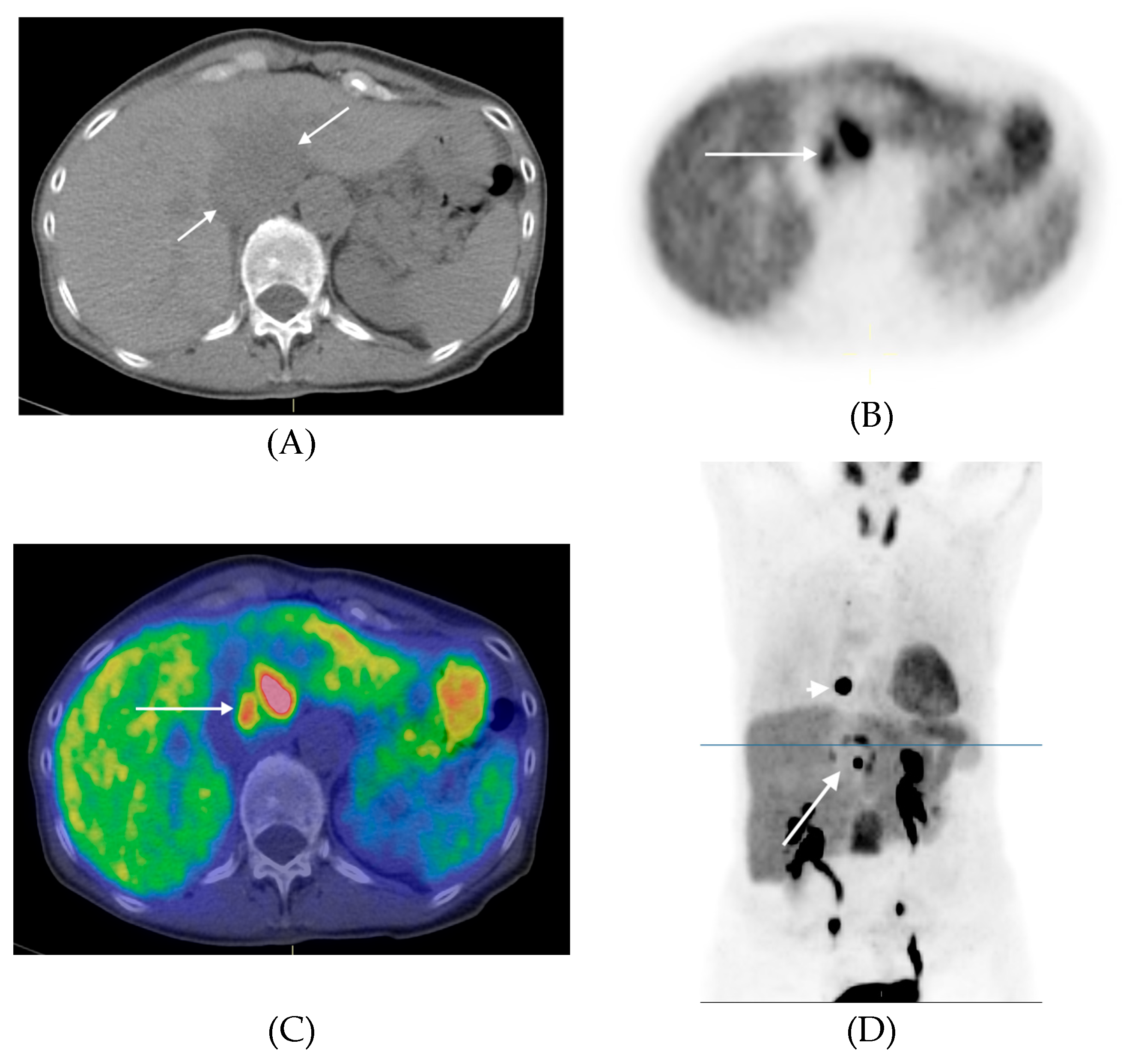 Cancers | Free Full-Text | 11C-hydroxy-ephedrine-PET/CT in the ...