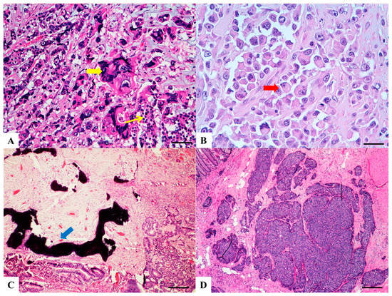 adenocarcinoma colon histology