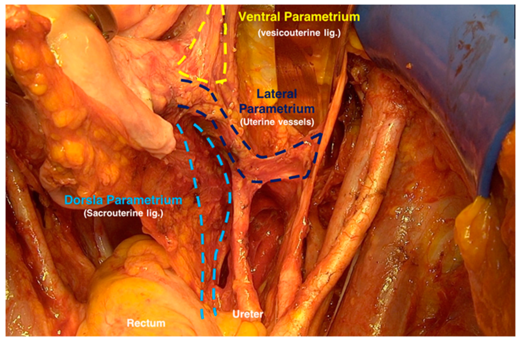 hysterectomy anatomy