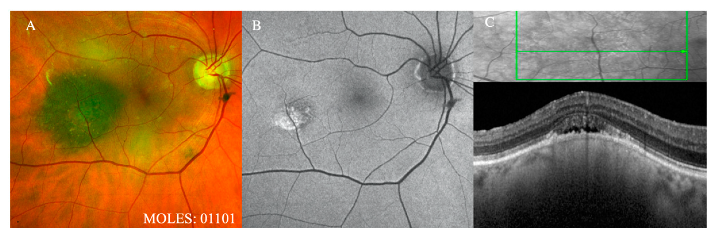 Cancers | Free Full-Text | The MOLES System for Planning Management of  Melanocytic Choroidal Tumors: Is It Safe?