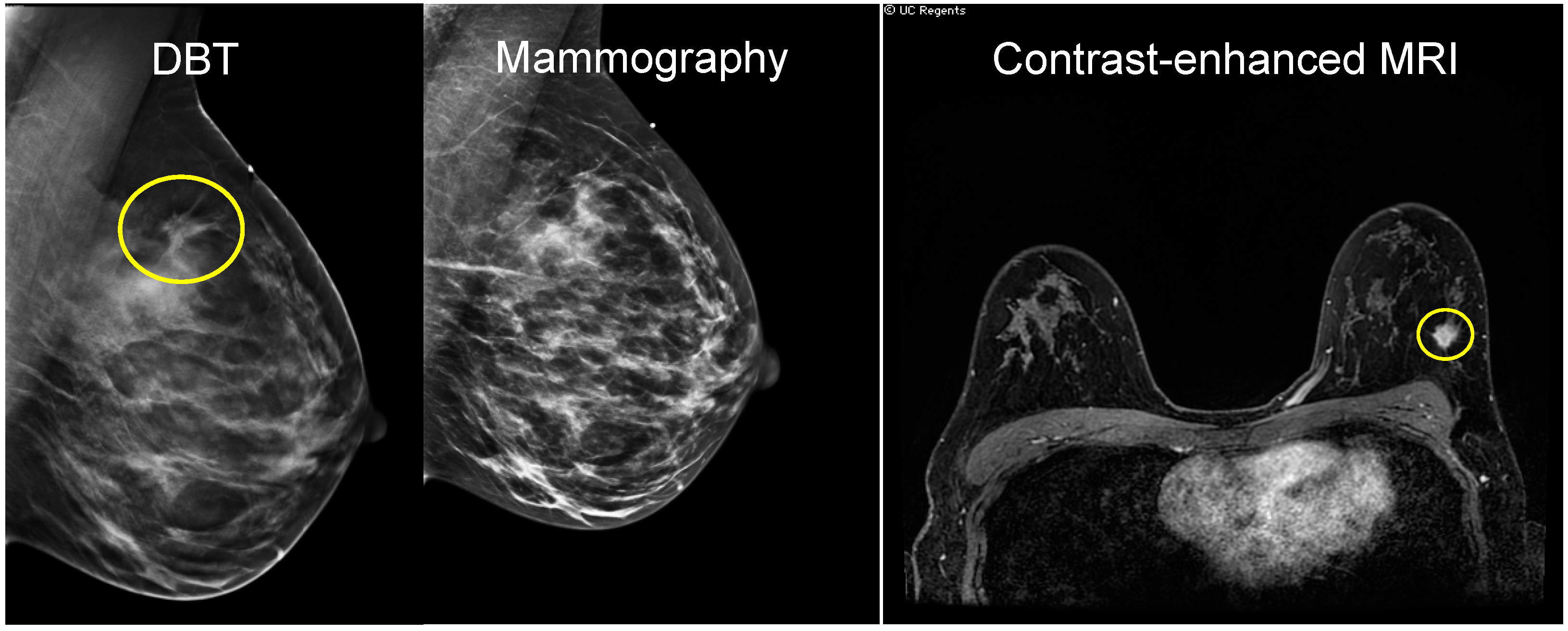 Breast Asymmetry - Radiology