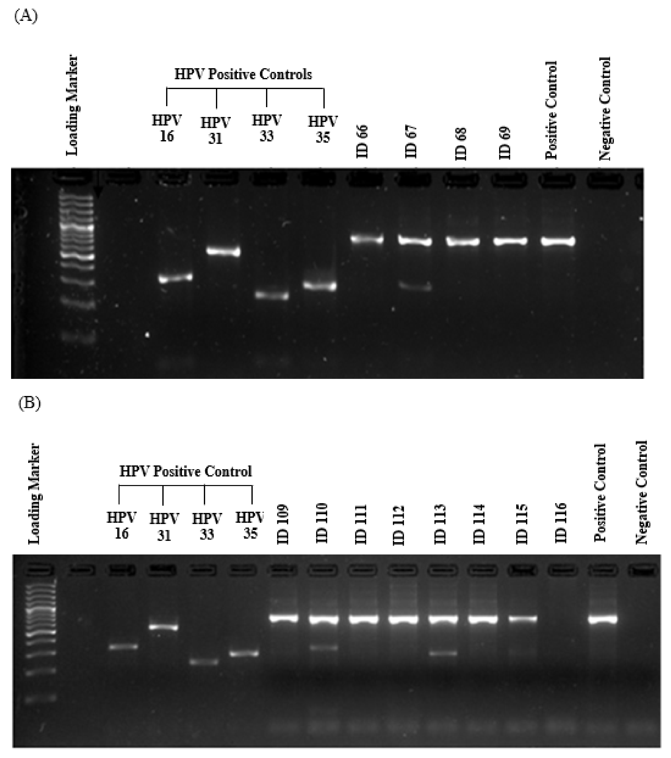 Cancers Free Full Text Prevalence And Type Distribution Of High Risk Human Papillomavirus Hpv In Breast Cancer A Qatar Based Study Html