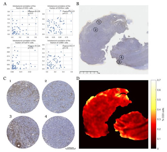 Cancers Free Full Text Sex Specific Differences In Primary Cns Lymphoma 