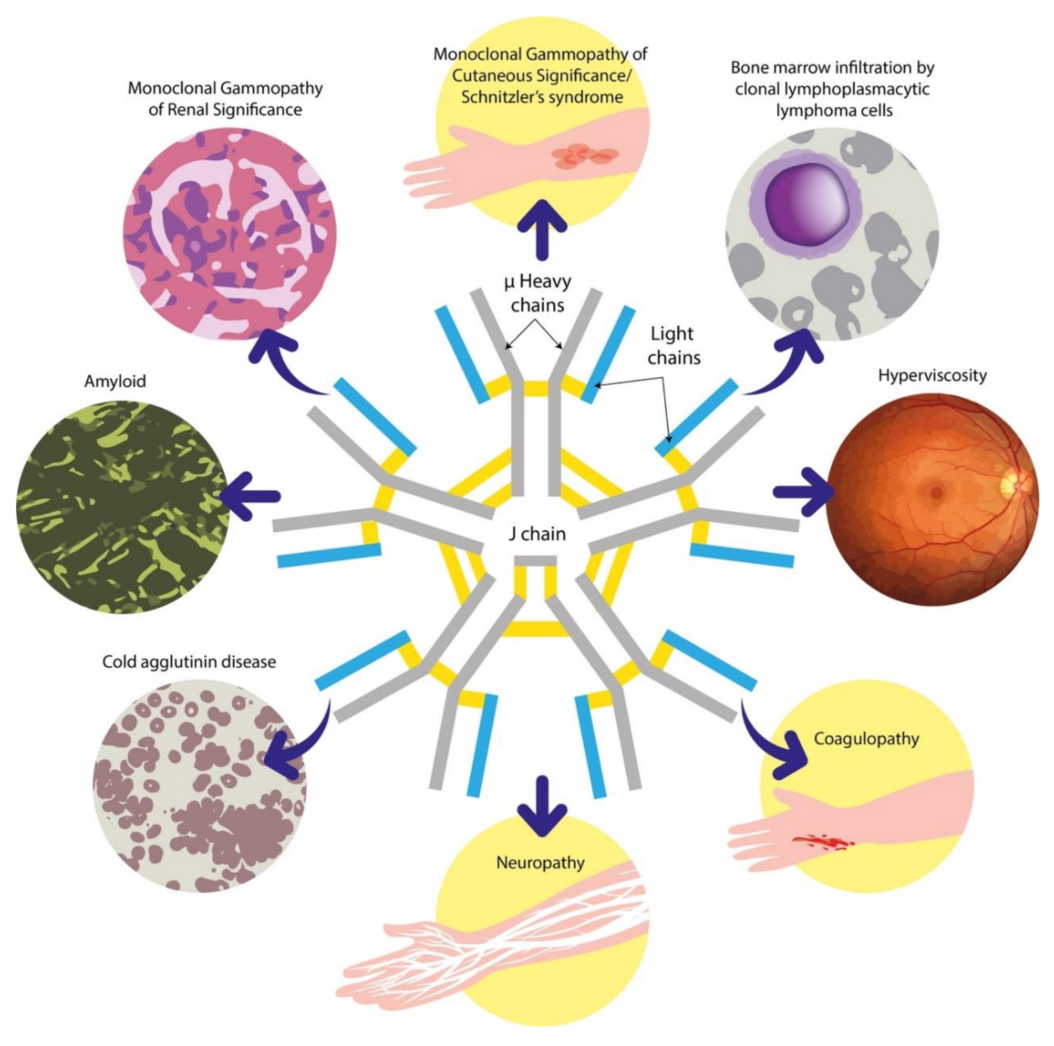 Cancers | Free Full-Text | Immunoglobulin M Paraproteinaemias