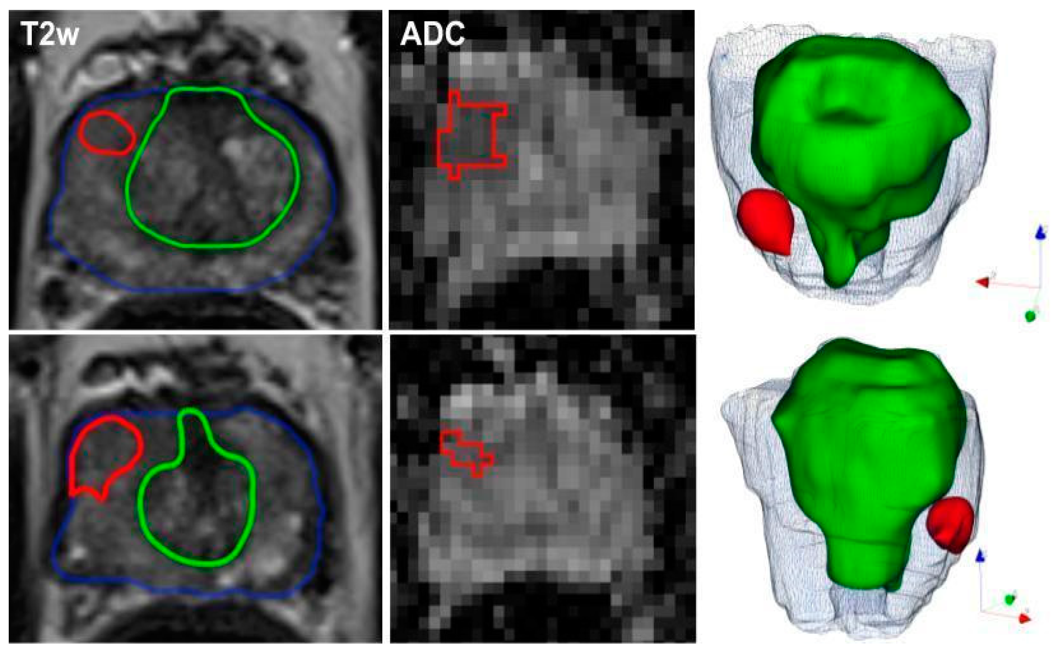 Cancers Free Full Text Multiparametric Mri For Prostate Cancer Characterization Combined
