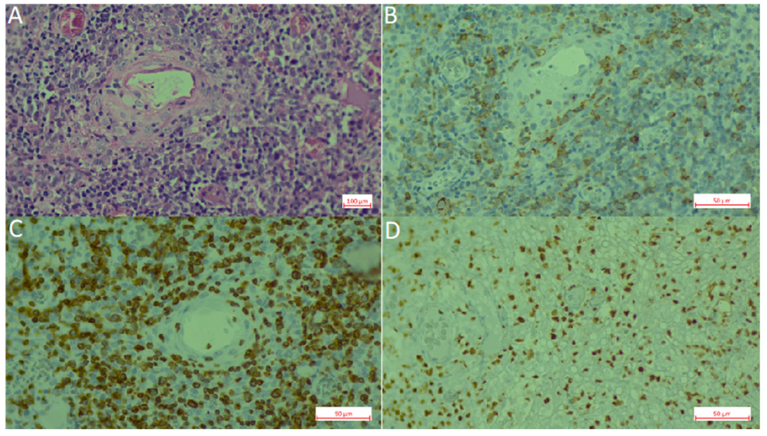 Cancers | Free Full-Text | Lymphotropic Viruses EBV, KSHV and HTLV in Latin  America: Epidemiology and Associated Malignancies. A Literature-Based Study  by the RIAL-CYTED