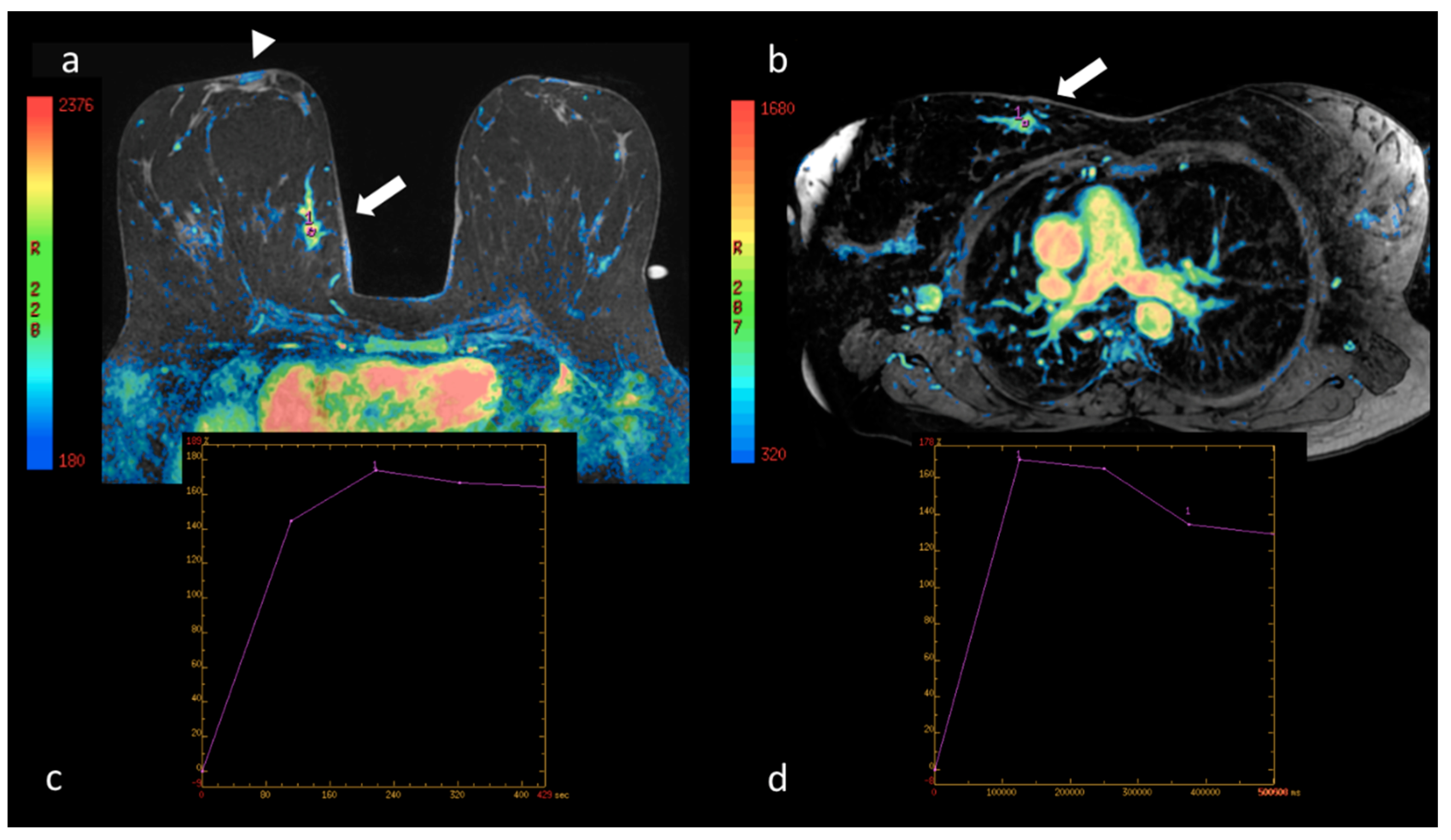 Breast volumes of human subjects in three scanning positions.