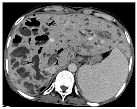 Cancers | Free Full-Text | Pathophysiology and Imaging Findings of Bile ...